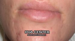 How to remove dark spots dua | wazifa to remove acne scars - Daagh dhabbe door karne ki dua