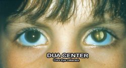 (WITHOUT OPERATION) Quranic treatment wazifa for eye cataract cure | Dua for eye cataract - Motiya bind ka wazifa | Motiya bind ka zabardast qurani ilaj