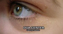 Powerful islamic wazifa for eyelid cyst cure | dua for eyelid cyst-Aankhon pe dana ka ilaj | Gohanjni se nijat ki dua