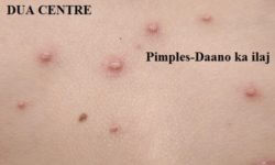 Effective wazifa to get rid of acne and pimples - Daano ka ilaj | daane khatam karne ki dua acne pimples treatment daane daano ka ilaj phunsi ka ilaaj wazeefa amal